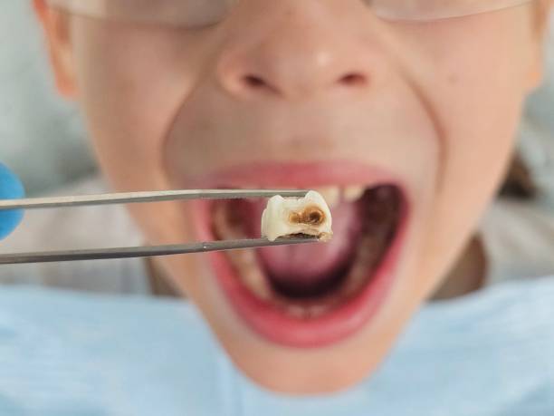 Best Emergency Tooth Extraction  in Lake Erie Beach, NY