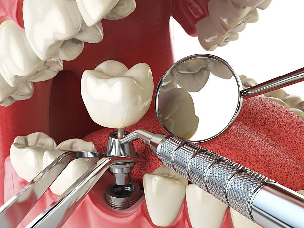 Best Knocked-Out Tooth Emergency  in Lake Erie Beach, NY